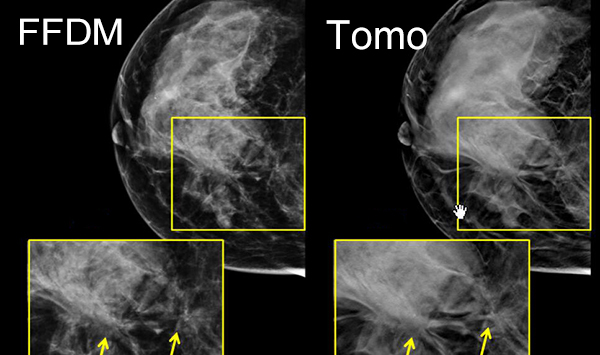 ffdm and tomosynthesis comparison 2